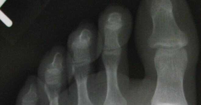 Vad är cpt koden för röntgen av vänster fotled tre vyerna.?