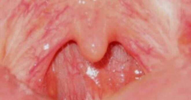 Kan en tonsillektomi orsaka nervskador?