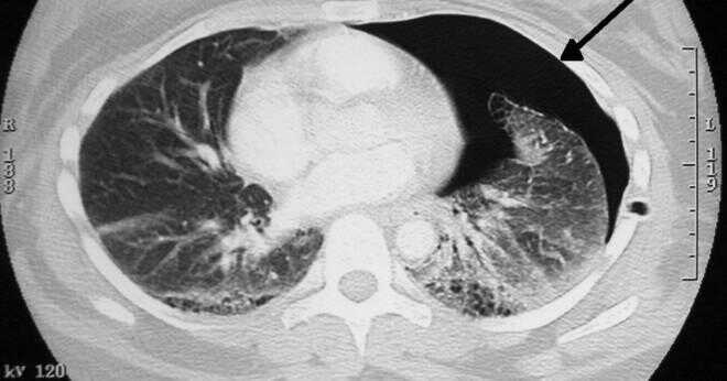 Kan orsaka knäckt revben en lunginflammation?