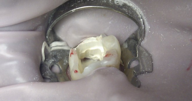 Kan orsaka tandlokalvård en rotfyllning?