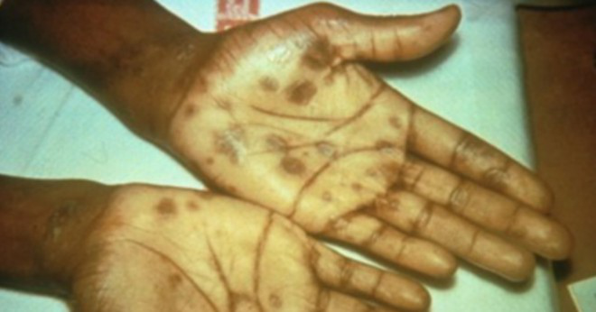 Vilka är symtomen av general paresis syfilis?
