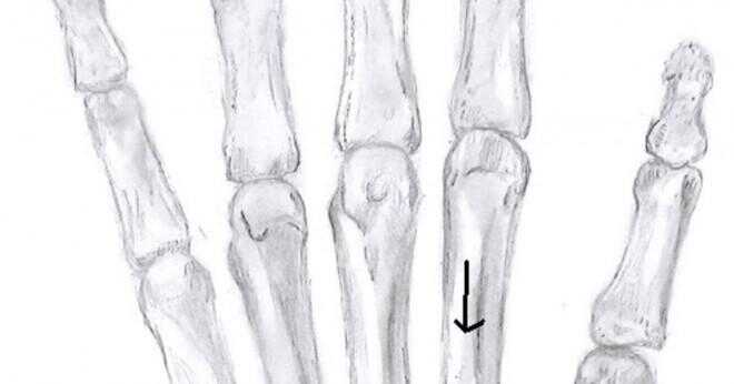Vilket är bästa övning för knä gemensamma smärta och artrit patienter?