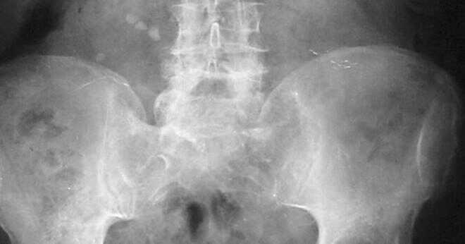 Vad är ureteric obstruktion?