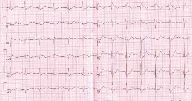 När används pacemaker för hjärtat block?