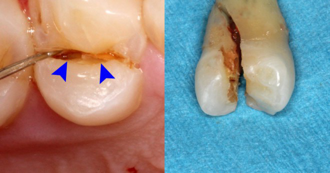 Hur vet du om du har en torr socket om du känner extrem smärta i hålet där tanden var?