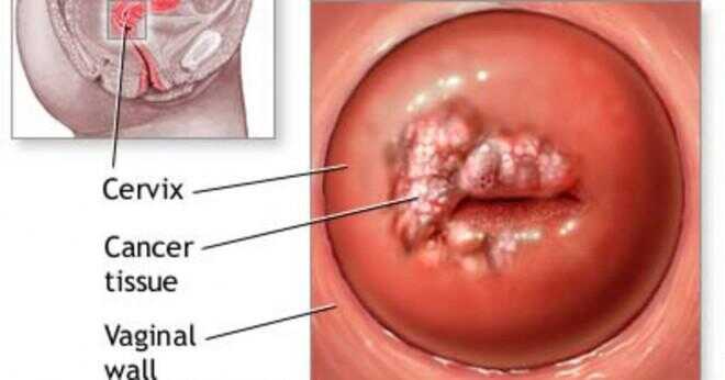 Livmoderhalscancer kan orsaka cancer i urinblåsan?