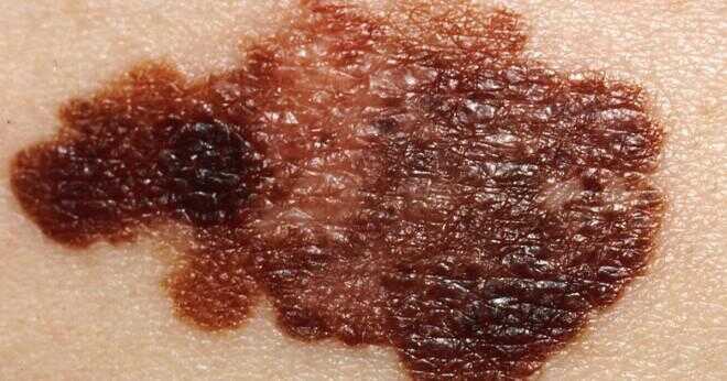 Gör huden cancer start som en fläck?