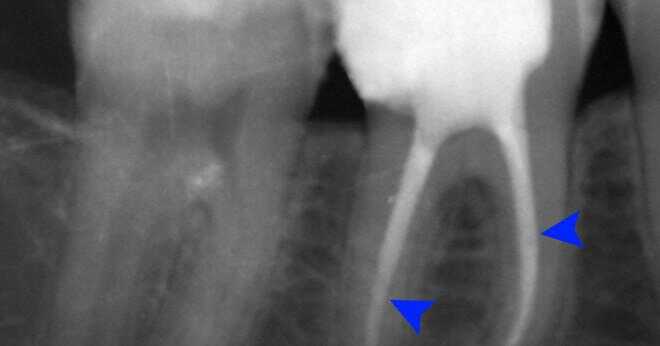 Har sickle-cell anemi orsakar skämda tänder?