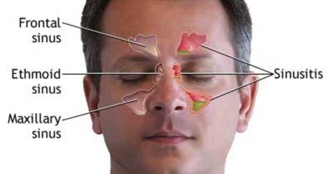 Kan en sinus-infektion orsaka ögon- och templet smärta?
