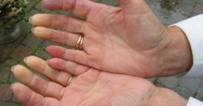 Vad skulle orsaka båda händerna att bli stel och smärtsamma med lagt till svullnad på fingrarna?