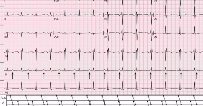 Vilka hjärtsjukdomar öka chanserna att en patient behöver en pacemaker?