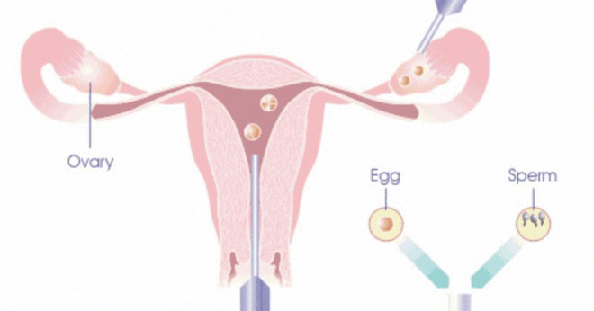 Hur kan ägg bevaras när det tas från äggstockarna?