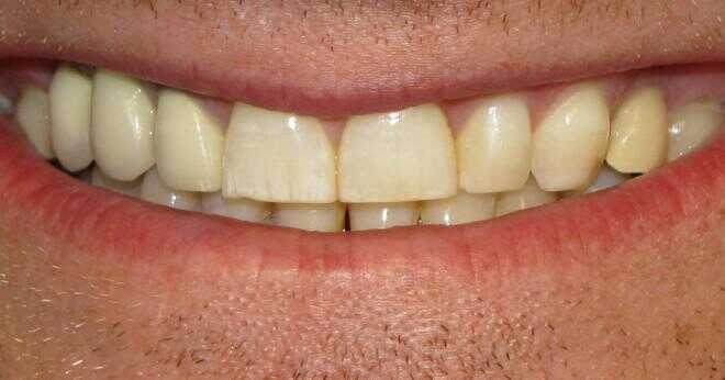 Finns det något en tandläkare kan göra för att få de kalkhaltig vita fläckar på tänderna?