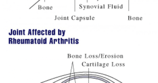 Hur lång tid tar det för artrit att visa upp på xrays?