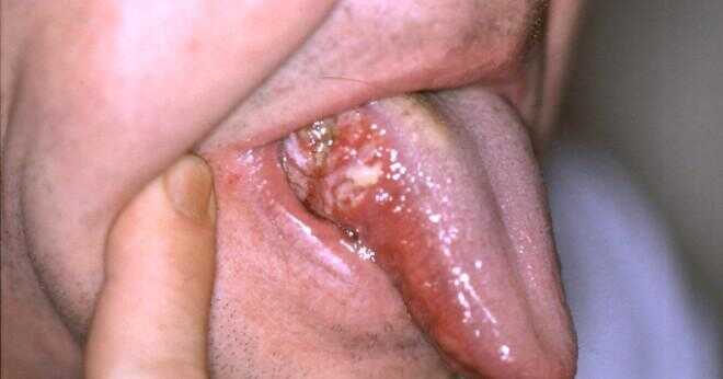Blåsor under tungan och brinnande tungan?