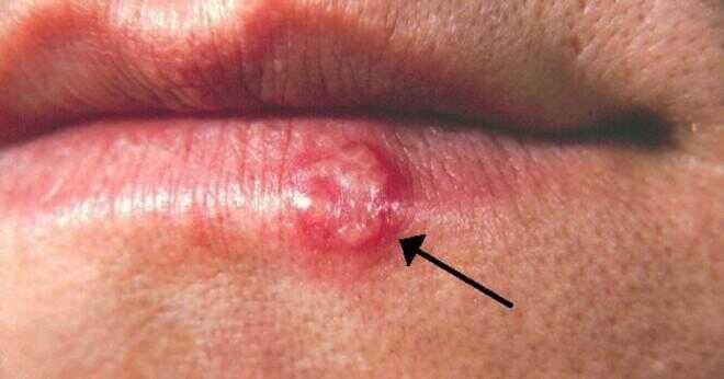 Gingivit kan överföras med kyssar?