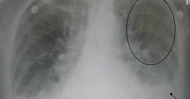 Flash lungödem ligger i vilken del av kroppen?