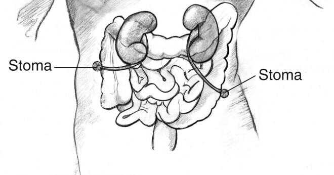 Vad är medicinsk term menande kirurgiska skapandet av en konstgjord öppning in i blåsan?