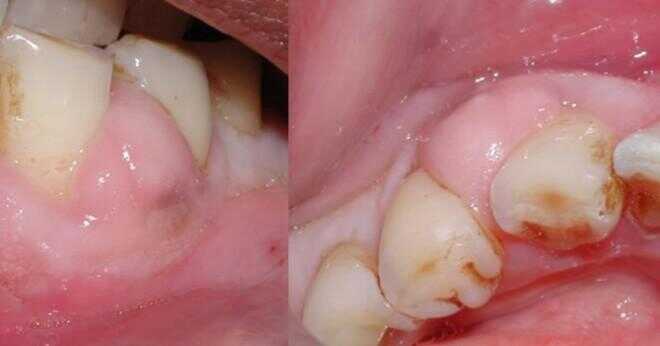 Efter att ha granskat din röntgenbild av en tand som hade rotfyllning 10 år sedan upptäcktes en infektion kan denna infektion behandlas med antibiotika i stället för att dra tanden?