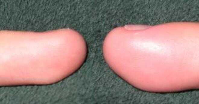 Varför fingrar och tår känner kallt efter använder nagellack?