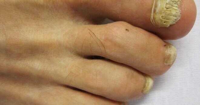 Varför är ditt finger naglar blir mörkare?