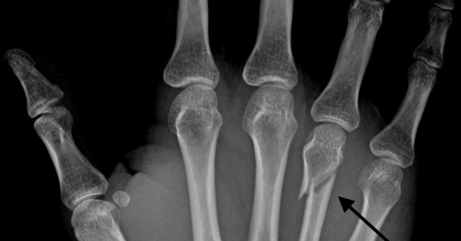 Hur lång tid tar det för en fraktur i mellanhandsbenet ben att läka?
