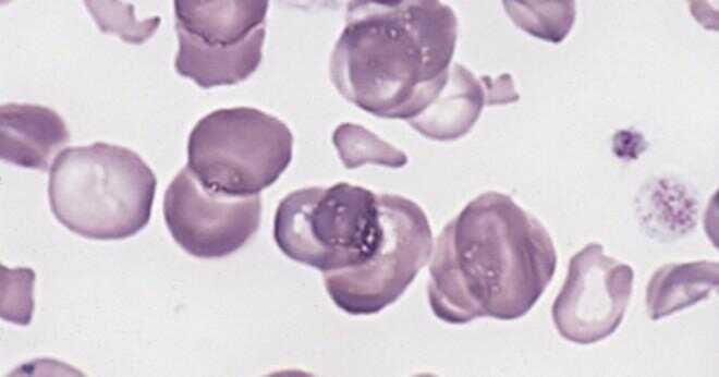 Vad är eldfasta anemi med ring sideroblasts?