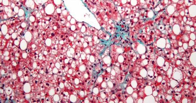 Vad är nedsatt echogenicity med hepatomegali lever?