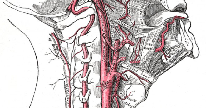Vad är att bygga upp av plack i artärerna?