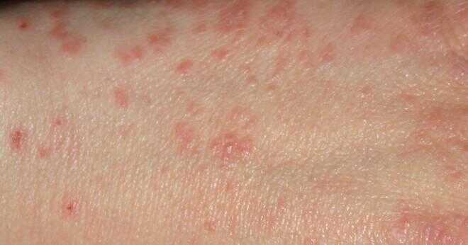 Varför blir myggbett stora röda klumpar under huden efter repor?