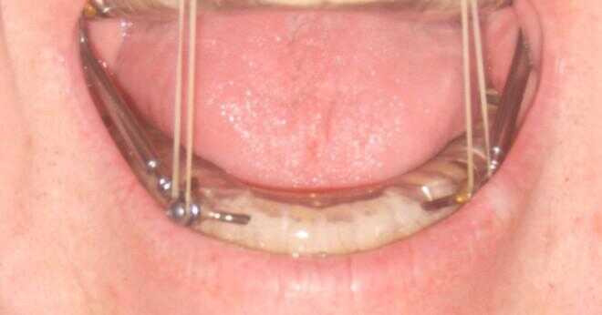 Vilket förfarande innebär en tonsillektomi?