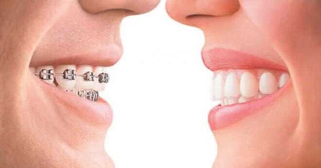 Gör eller orthofill tänder band verkligen fungerar?