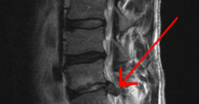 Vad är bakre diskbråck i L5-S1 inkräkta på den främre delen av ryggmärgen?