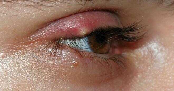 Vilken typ av smärta är associerad med eyelift kirurgi?