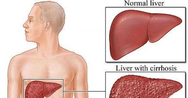 Är det sant saliv kan orsaka hepatit b-infektion så hur?
