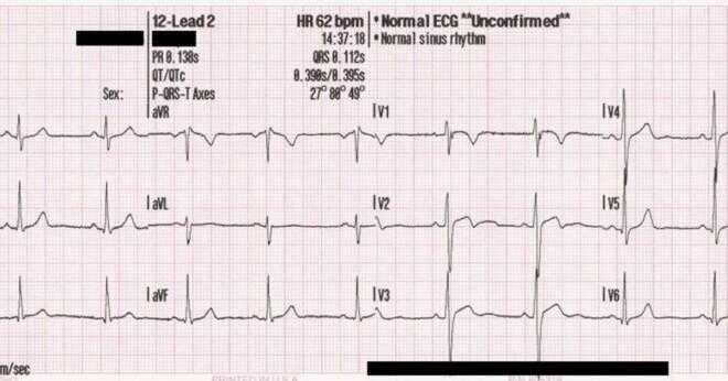Vad representerar en liten q-våg på ett EKG?