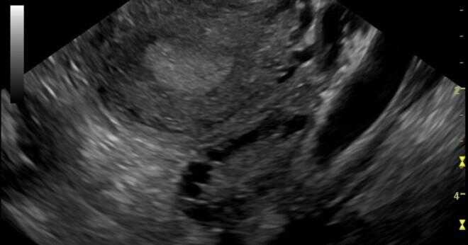 Vad orsakar polycystiskt ovariesyndrom?