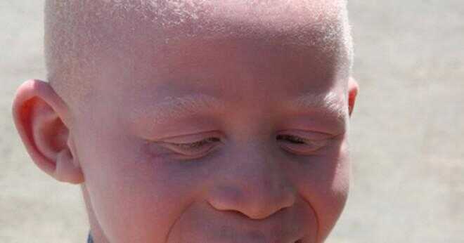 Finns det några tester för att se om någon har albinism?