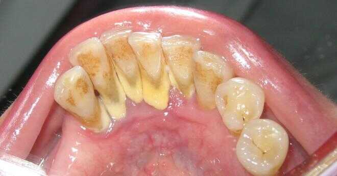 Den härdade insättning som bildar på tänderna och irritera omgivande vävnader kallas?