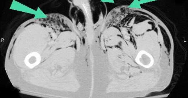 Skiljer sig emfysem i lungcancer?