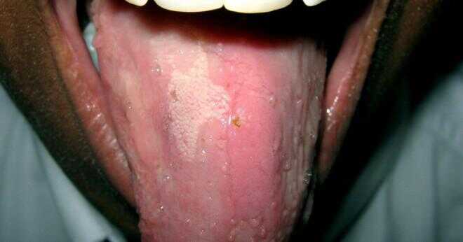 Är det normalt för tungan som en vit färg efter en tunga piercing?