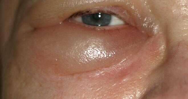 Vad orsakar svullna ögon?