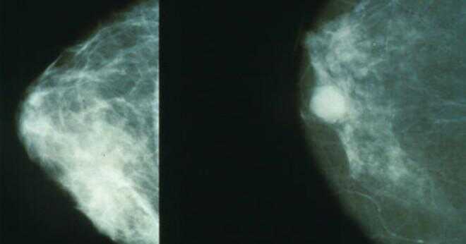 När bör kvinnor genomgår mammografi?