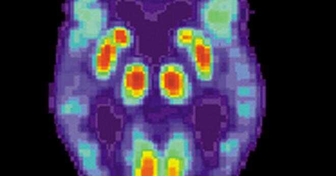 Tidigt ingripande av Alzheimers sjukdom bromsa utvecklingen av sjukdomen?