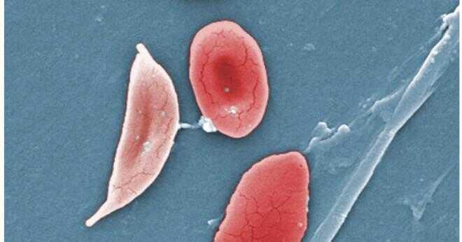 Hur sprids sickle-cell anemi?