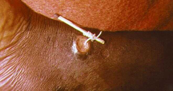 Vad är guinea worm infektion kallas även?