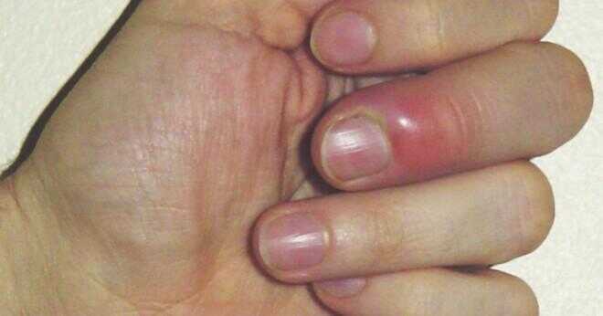 Vad är det värsta sättet att bli av med en nagelrot?