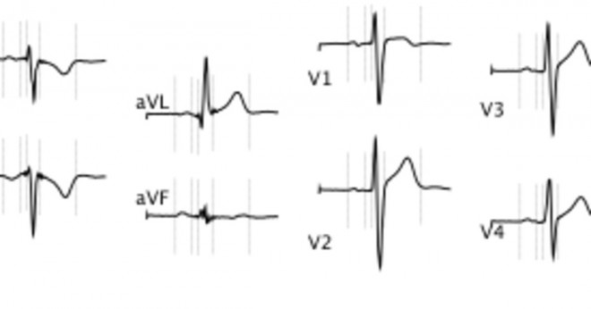 Är mänskliga artärtryck vågformen bredare än EKG-kurvan?