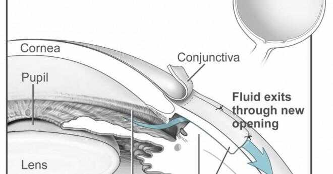 Vad är en stängd vinkel glaukom?