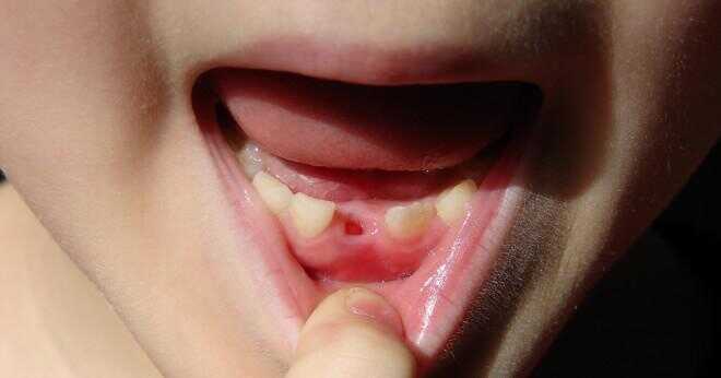 I vilken ordning bör barnets nya tänder dyka upp?